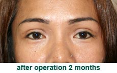 plastic-surgery-blepharoplasty